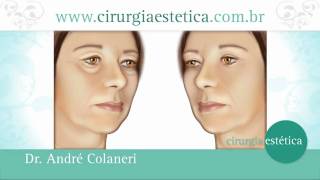 Cirurgia das Pálpebras  Blefaroplastia  Cirurgia Plástica Dr André Colaneri [upl. by Eissert]