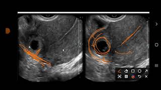 interstitial Ectopic pregnancy [upl. by Timotheus]