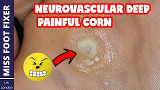 Neurovascular DEEP PAINFUL Corn Removal  Full Thickness Corn  BY MISS FOOT FIXER [upl. by Nonnac]