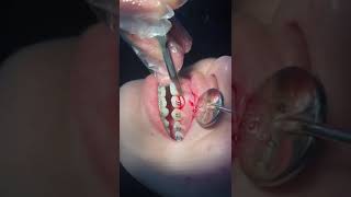 Gingivectomy for orthodontics treatment [upl. by Rennob151]