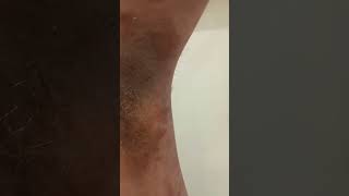 Armpit eczema and rash with so much pain [upl. by Aldwon873]