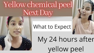 Yellow Chemical Peel  Next Day After Using Peel  Yellow Peel करने के बाद अगले दिन का face [upl. by Ennovart]