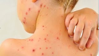 How To Cure Scabies Natural Itch Relief For Scabies What Is Scabies Rash Natural Cure [upl. by Diehl778]