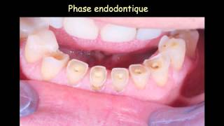 Cadcam clinical case CFAO et cas complexe CFAO directe [upl. by Fiore]