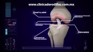 Clinica de Rodillas  Ruptura Parcial Ligamento Cruzado Anterior LCA  México [upl. by Hannan]