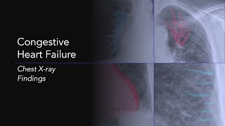 Congestive Heart Failure Explanation of Chest Xray Findings [upl. by Casar]