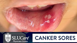 Determining Causes amp Treatment for Canker Sores  SLUCare Otolaryngology [upl. by Arec]