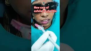 New case of exfoliatve cheilitis treated by Laser [upl. by Latsyrc968]