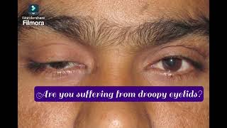 Are you suffering from droopy eyelidsDon’t hesitate to see your Oculoplasty Surgeon [upl. by Fons]