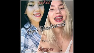 Diastema Dentes separados Antes e depois do aparelho 😯🥰 [upl. by Willyt]