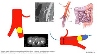 Acute Limb Ischemia [upl. by Ait]