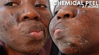 CHEMICAL PEEL FULL PROCESS AT HOME USING JESSNERS PEEL  BEFORE amp AFTER [upl. by Thinia400]