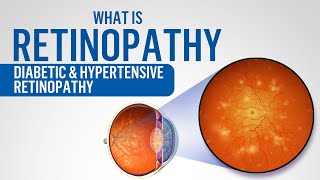 What is Retinopathy  Diabetic retinopathy  Hypertensive retinopathy [upl. by Dorkus]