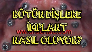 Bütün dişlere implant nasıl olur Hiç diş olmayan ağızda implant uygulanması hakkında bilgilendirme [upl. by Vescuso]