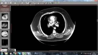 CT Computertomographie Lungenembolie Videoanalyse [upl. by Holladay]