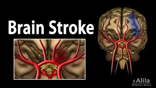 Brain Stroke Types of Causes Pathology Symptoms Treatment and Prevention Animation [upl. by Shetrit]