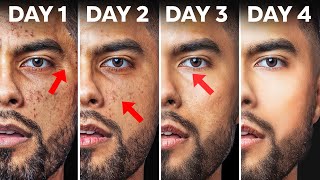 How To Fix Your Skin in 4 Days Use At Home Products [upl. by Kcinemod]