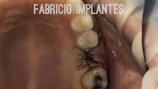 EXTRAÇÃO DO MOLAR SUPERIOR COM IMPLANTAÇÃOE ENXERTO ÓSSEO  FABRICIO IMPLANTES – ARUJÁSP [upl. by Fawnia]