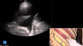 3D Lehrvideo Ultraschallgestütze Thoracentesis Untersuchung  SonoSite Ultraschall [upl. by Letnuhs]