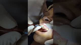 Gingivectomy RFcauterycrownlengthening [upl. by Revilo749]