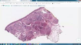 Lecture 8Granulomatous Disorders in Skin [upl. by Perloff]