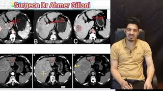 Triphasic CT SCAN typical of Hepatocellular Carcinoma Explained Simply FCPS  CPSPMD [upl. by Anitsrhc]