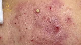 Treatment of pustules and inflammatory acne 84  Loan Nguyen [upl. by Lareneg]