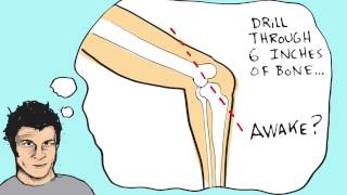 MAT HOFFMAN AND THE LARS LIGAMENT [upl. by Aihsia]