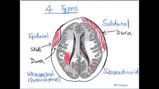 Intracranial Bleed  Part 1 [upl. by Kamp268]