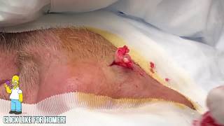 Deep Deep Deeper Cyst Removal [upl. by Safier31]