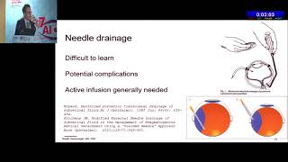 AIOC2019 GP035 Topic 3 Sub – retinal fluid drainage  Indications dry tap and Different techniques [upl. by Adelric]