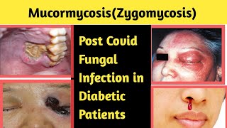 Mucormycosis Zygomycosis  Fungal Infection Post Covid [upl. by Onit476]