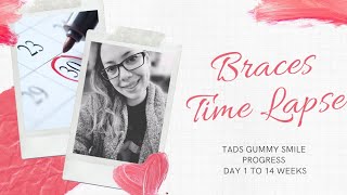 Time lapse with TADs Gummy smile correction [upl. by Alrep]