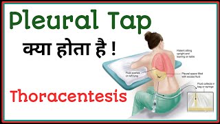 pleural tap in hindi  thoracentesis  pleural effusion drainage technique shorts pleuraleffusion [upl. by Acinemod]