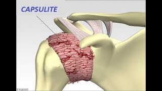 Capsulite Adesiva ou Síndrome do Ombro Congelado  Causa oculta de dor intensa e rigidez do Ombro [upl. by Laughry]