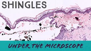 Shingles under the microscope VZV Varicella Zoster Herpes pathology dermpath dermatopathology [upl. by Carrel]