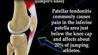 Patellar Tendonitis Jumpers Knee  Everything You Need To Know  Dr Nabil Ebraheim [upl. by Victoir49]