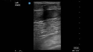 Knee Ultrasound Suprapatellar Bursa No Effusion Part 2 [upl. by Harehs]