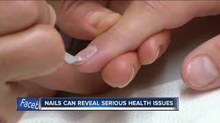 Doctors warn to check your nails for dangerous skin cancer [upl. by Ademla986]