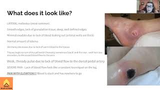 Arterial Insufficiency Ulcer  NPTE Prep [upl. by Toole]