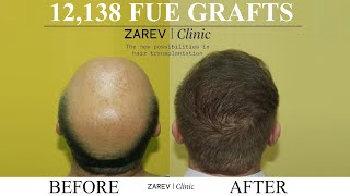 FUE Hair transplant result 12138 Scalp grafts Dr Zarev Bulgaria [upl. by Eixid68]