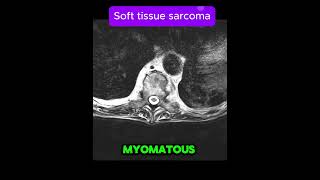 Soft tissue sarcoma with vertebral metastases [upl. by Shanney562]