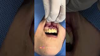 Dressing Application at Gingival Periodontal Surgery ASMR [upl. by Aifos]