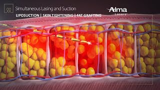 Liposuction Skin Tightening amp Fat Grafting  Lipo Life by Alma Lasers Medical Device 3D Animation [upl. by Schonfield]