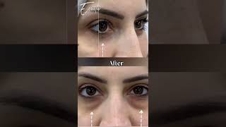 Whats the impact of BlepharoplastyHow its look before and aftercosmeticsurgerybeautyskincare [upl. by Angelica]