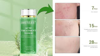 ব্রন স্কিনের জন্য সেরা টোনার Breylee Acne Treatment Toner [upl. by Ries]