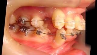 Orthodontic libraryHK Dental crowding Protruding teeth Chart No4730 [upl. by Saleme]