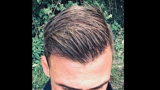 HAIR TRANSPLANT With 4500 Grafts NW45 Excellent Result With Fine Hair [upl. by Kask]