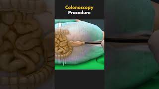 How Colonoscopy is performed 3dmedicalanimation ytshorts medical3danimation [upl. by Sparky]