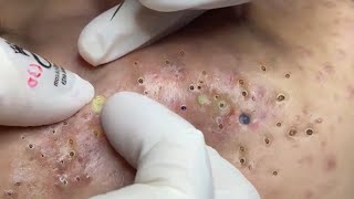 Big Cystic Acne Blackheads Extraction Blackheads amp Milia Whiteheads Removal Pimple Popping  292 [upl. by Orgel729]